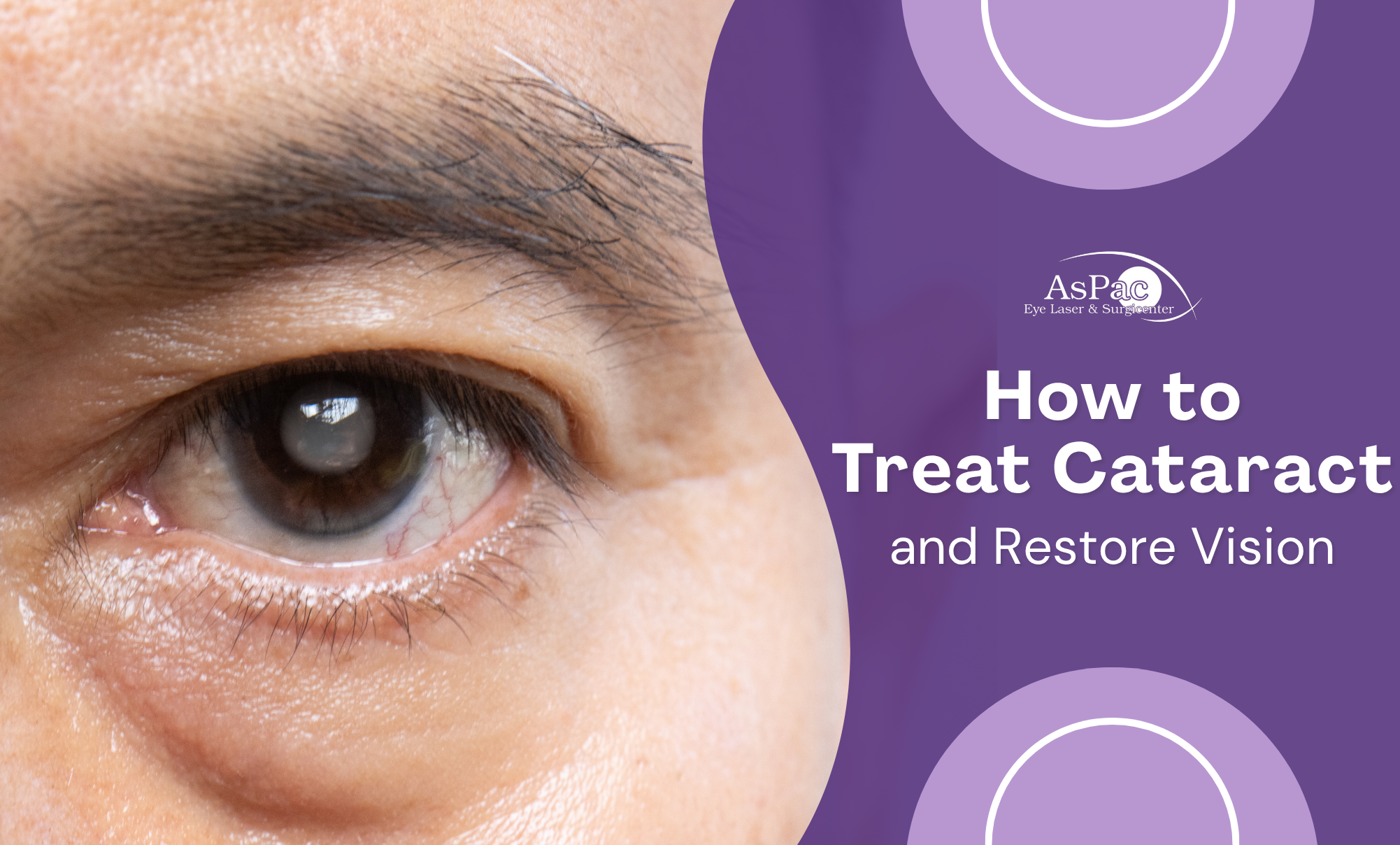 How to treat cataract | Laser eye surgery